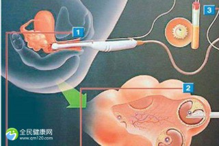 做试管要检查几次卵巢吗？