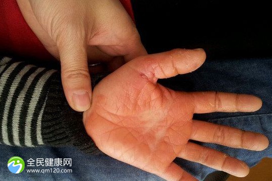 试管婴儿囊胚用什么冻起来？