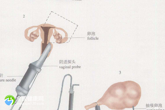 三代试管女要做地贫筛查吗？