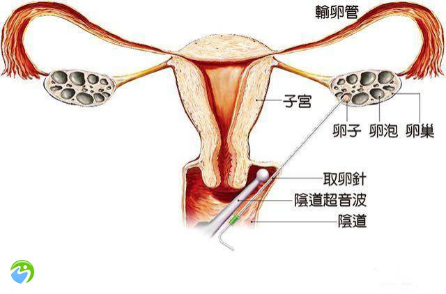 子宫内膜薄试管前怎样调理？