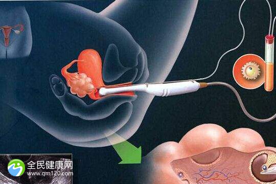 试管后如何让卵巢恢复？