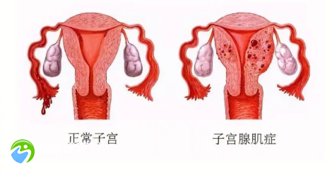 子宫内膜薄粘连能做试管吗？