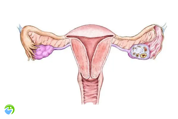 试管移植导致卵巢增大的原因，试管婴儿移植后卵巢增大怎么办？