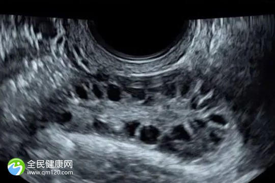 输卵管完全钙化可以做试管婴儿吗？