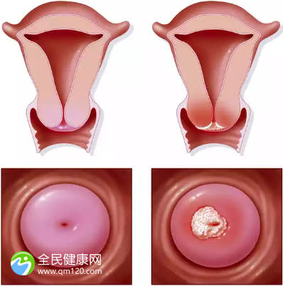 子宫小做试管的成功几率是多高？