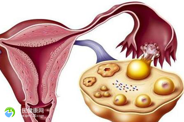 卵巢囊肿破裂手术治疗？怀孕子宫破裂会怎么样？