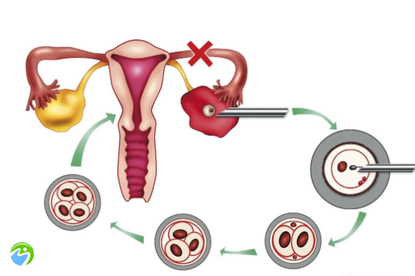 单边卵巢做试管的成功率多少？
