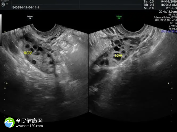 卵巢旁混合回声区是什么意思？卵巢早衰怀孕初期症状 