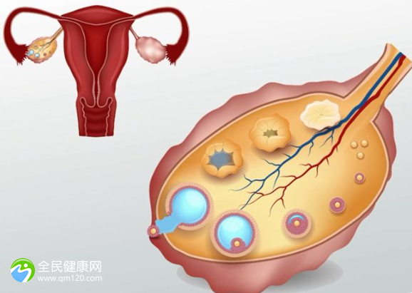 卵巢囊肿试管用什么方案好一点呢