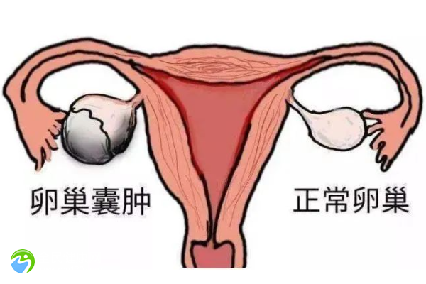 有卵巢囊肿的女人能自然怀上孩子吗？