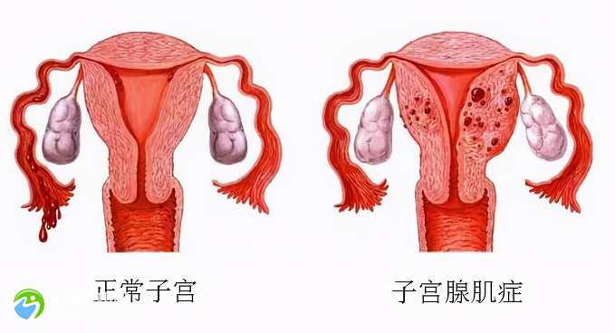 试管促排子宫肌瘤变大多少？试管促排子宫肌瘤变大多少算严重？