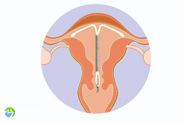 疤痕子宫可以做试管婴儿吗？多少钱？