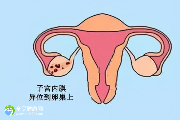 子宫内膜结核试管婴儿成功几率有多高？