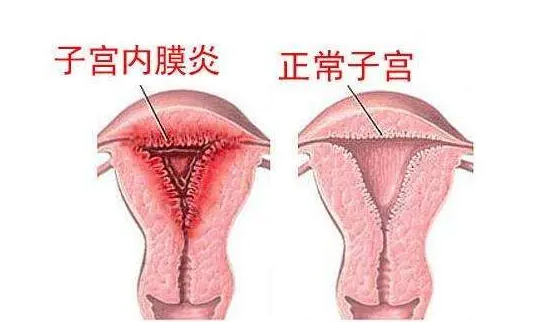 有子宫炎症可以做试管婴儿吗