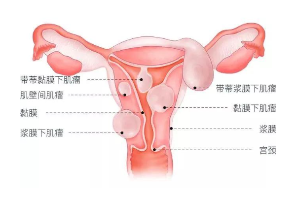 有子宫肌瘤能不能做试管婴儿