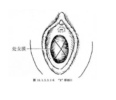 处女膜闭锁能不能做试管婴儿