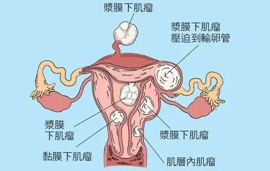 子宫后壁肌瘤能不能做试管婴儿