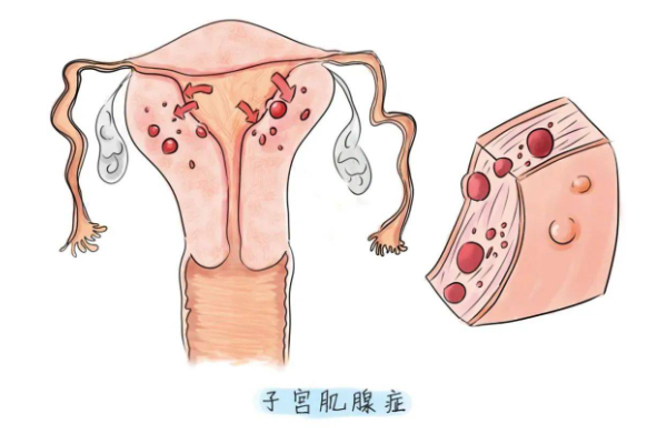 腺肌症能不能做试管婴儿