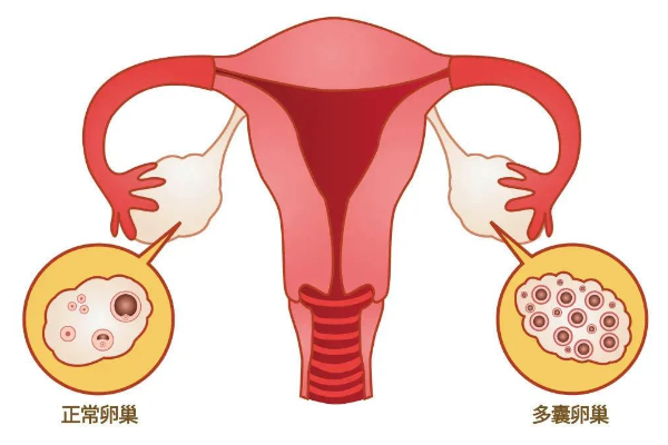 多囊卵巢可以做试管吗