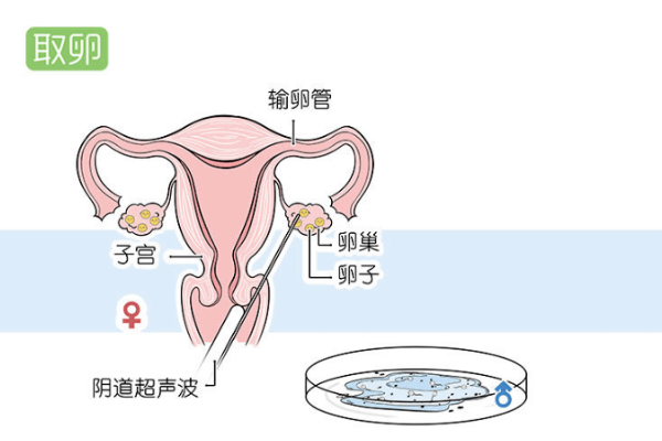 女人试管全过程是怎样的