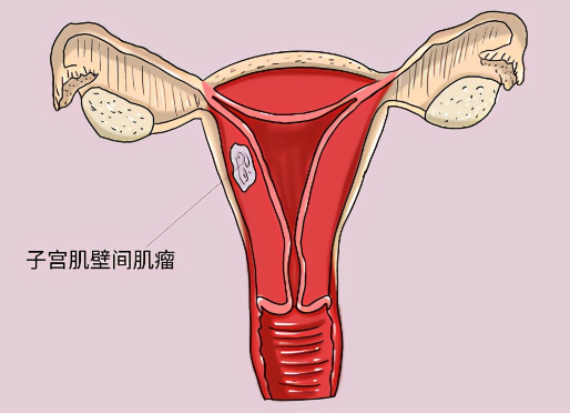 子宫腺肌症能成功怀孩子吗