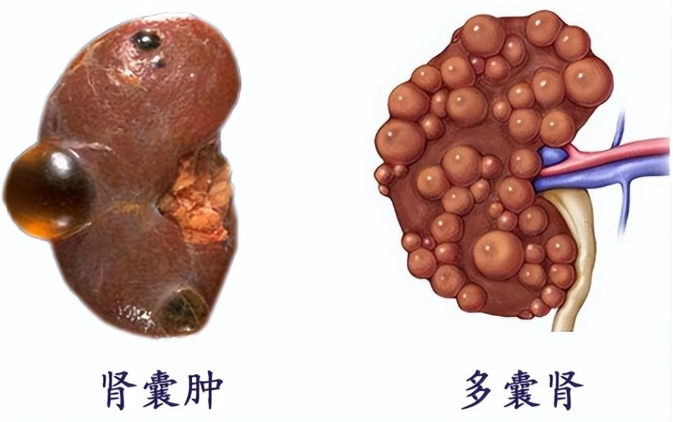 多囊肾做三代试管可以阻断遗传吗