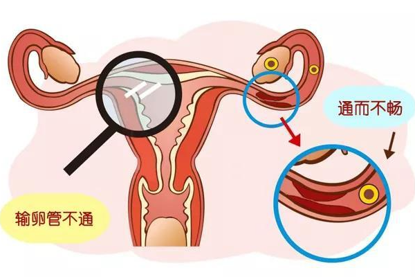 管腔闭塞能不能做试管婴儿