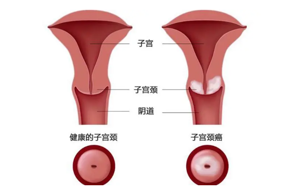 宫腔狭窄可以做试管婴儿吗